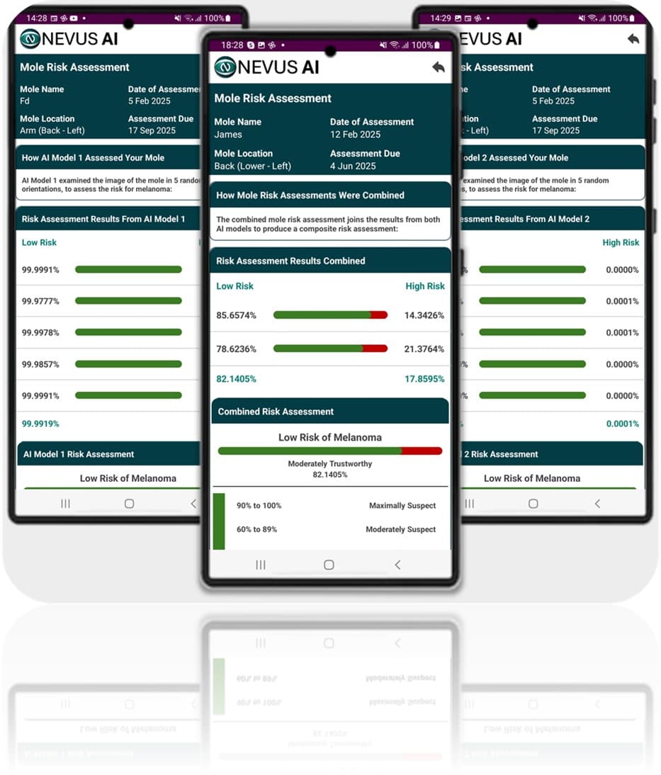 How does Nevus AI assess your mole for the risk of melanoma.