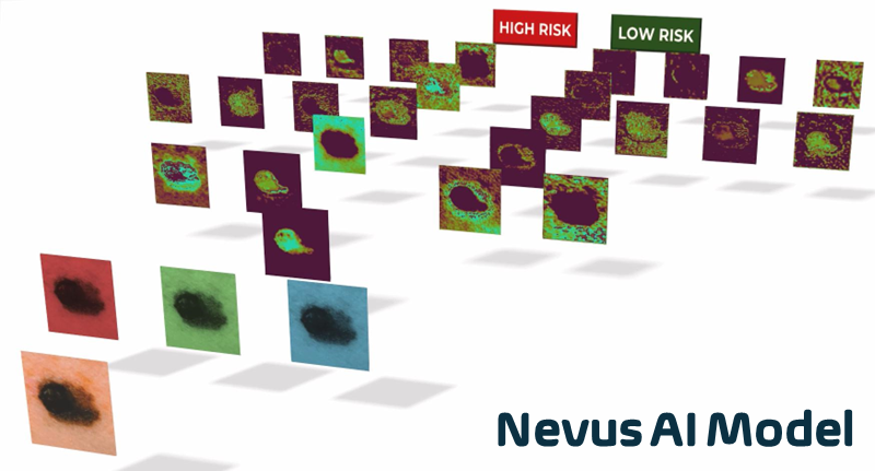 The Nevus AI model