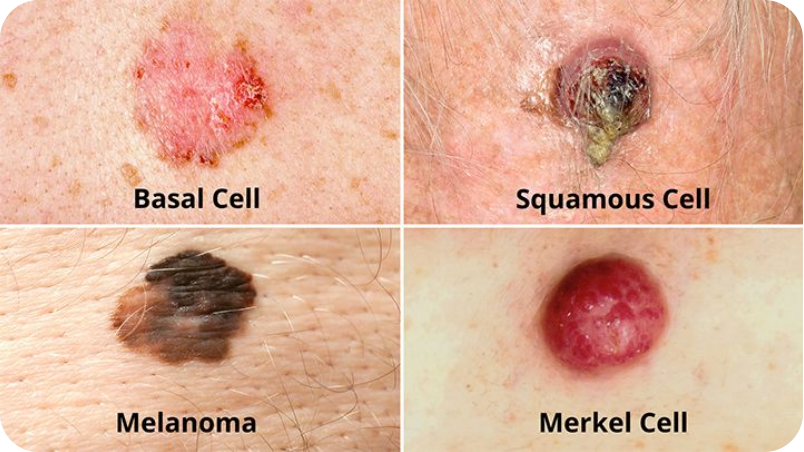 Different forms of skin-cancer.